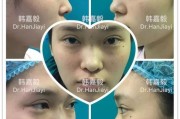 近视镜鼻子塌陷怎么改善，近视镜鼻子塌陷怎么改善视频