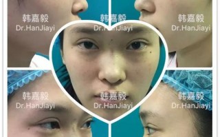 近视镜鼻子塌陷怎么改善，近视镜鼻子塌陷怎么改善视频